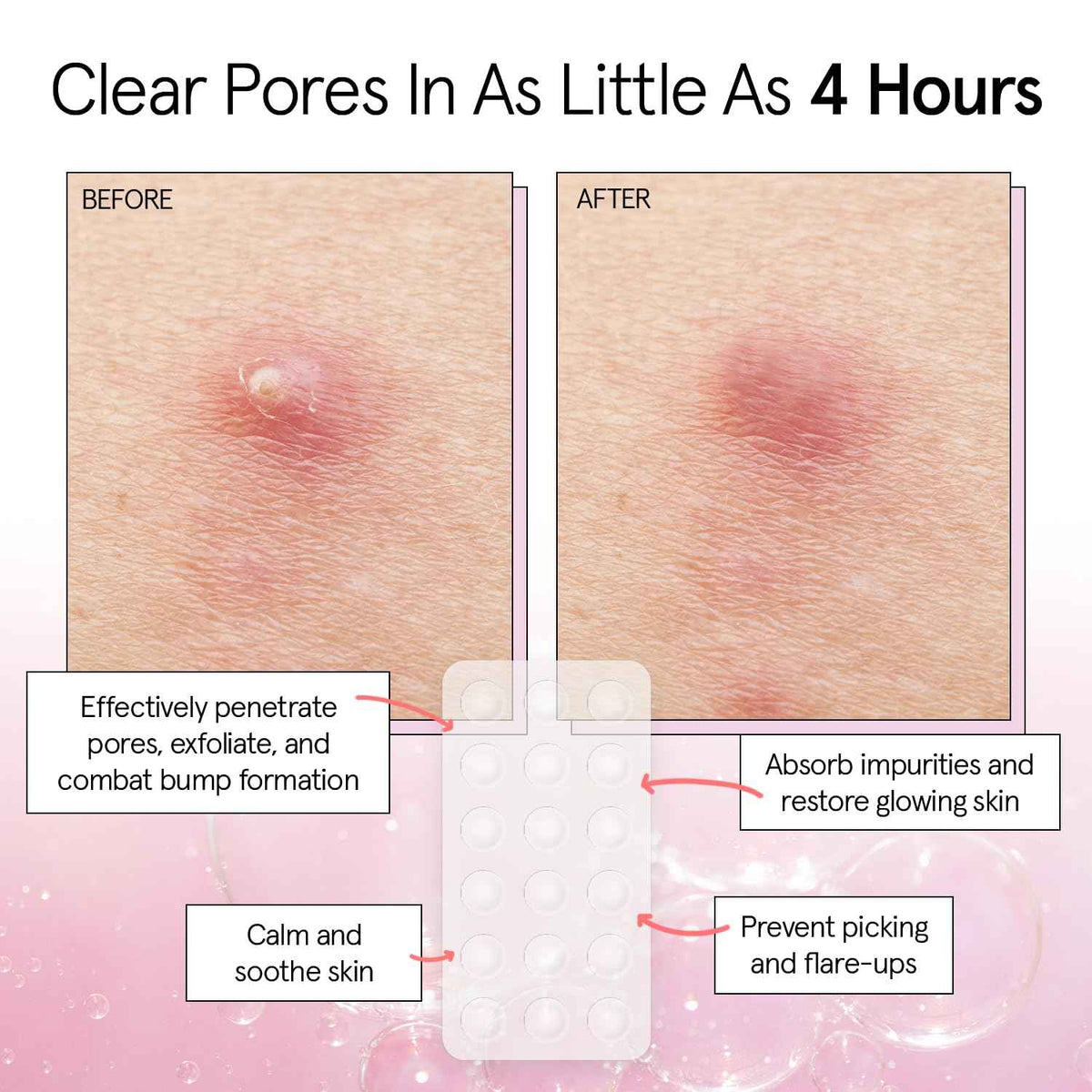 grace & stella Award Winning Invisible Spot Covers with Hydrocolloid (Round, 72 Count) - Spot Covers with Salicylic Acid and Tea Tree for Absorbing Impurities - Dermatologist Tested Skin Care, Cruelty Free, Vegan 🍁 All In One Marketplace Canada